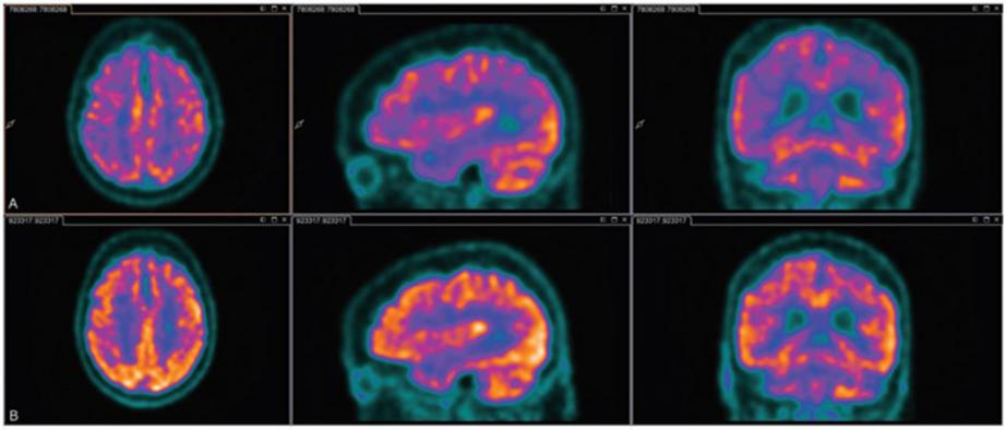 Infographic: The top row is the delirium PET scan, the bottom one is after the delirium. The darker colours show lower glucose metabolism in the brain. (Supplied: Journal of Cerebral Blood Flow & Metabolism) 