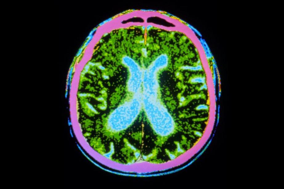 The disease is caused by the gradual loss of dopamine-producing cells