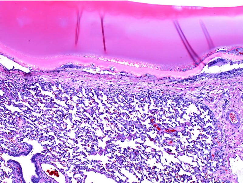 In an in vivo porcine lung incision model, photocrosslinked MeTro gel efficiently seals punctures in the animal’s lungs. In this staining the hydrogel is in the top and lung tissue in the bottom section. 