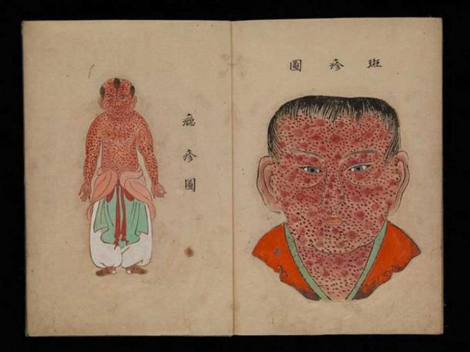 Watercolor illustration from a Japanese work on smallpox entitled Toshin seiyo [The essentials of smallpox]. ( CC BY 4.0 )