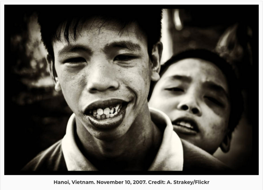 The third-generation child of an Agent Orange victim. Despite the generations between him and the Vietnam War, this boy still feels the effects and lives in a special village for Agent Orange victims.