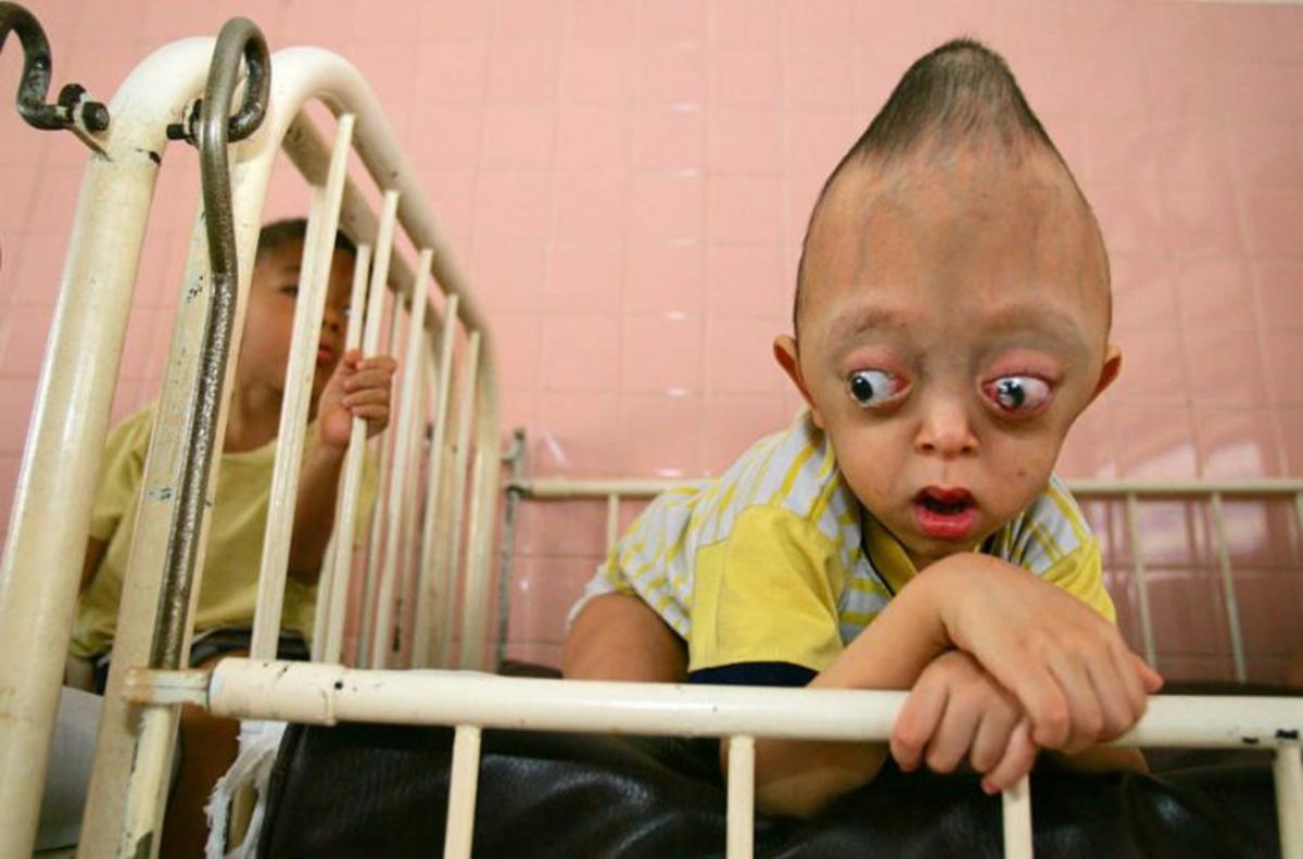  A Vietnamese child born with severe birth defects as a result of exposure to Agent Orange during the Vietnam War.